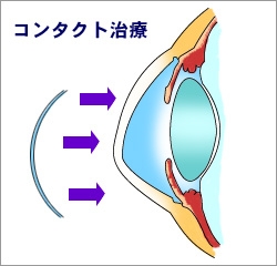 コンタクト治療