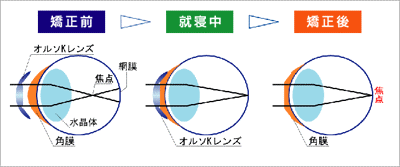 オルソケラトロジーのイメージ図