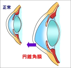 円錐角膜とは