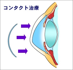 円錐角膜の治療方法