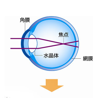 装用前：近視の状態