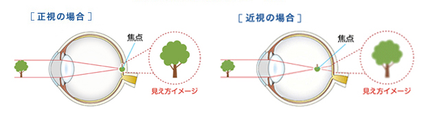近視ってなに？